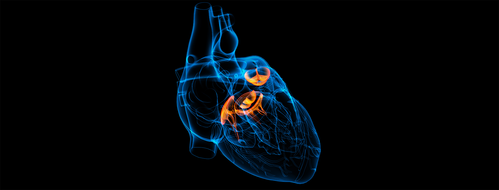 Structural heart and heart valve disease program at the Sarver Heart Center