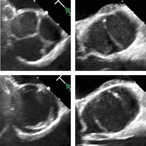  Echocardiographic images of normal aortic valve (closed =A, open = C) and bicuspid aortic valve (closed =B, open = D)