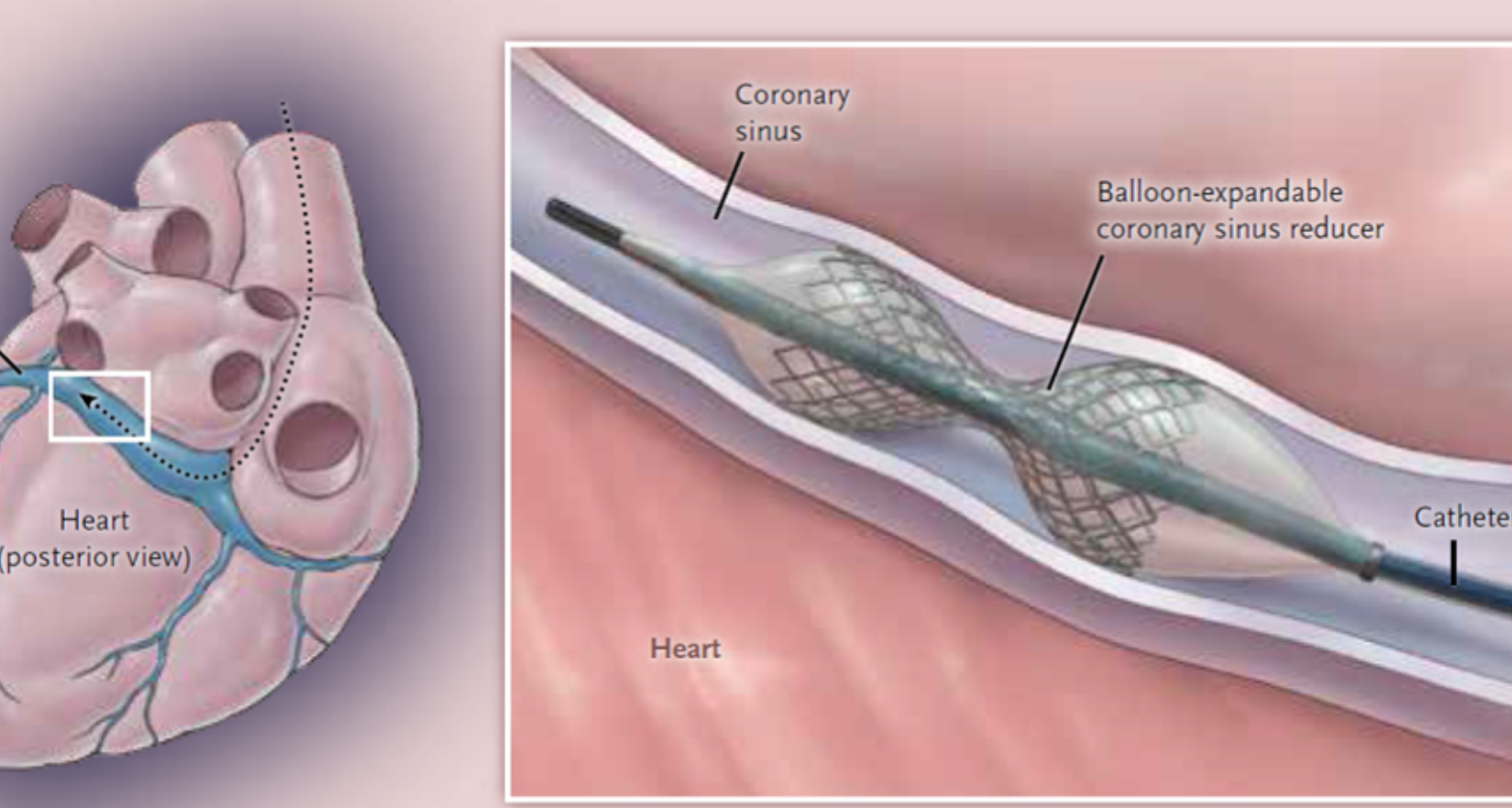 Coronary Sinus Reducer TM